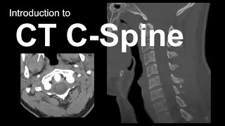 CERVICAL RADICULOPATHY Common Symptoms and Treatment Options  Dr Javier Reto [upl. by Adekahs]