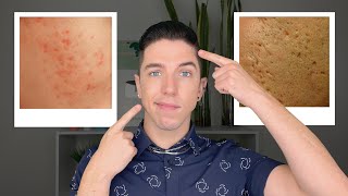 How to Get Rid of Acne Scars [upl. by Malcah]