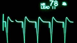 Ventricular Pacing [upl. by Belamy]