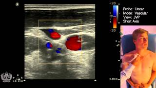 JVP Jugular Venous Pulsation Evaluation using Ultrasound [upl. by Kra932]