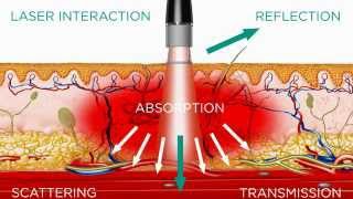 Retinal Tear Laser Surgery  COMPLETE GUIDE [upl. by Turne]