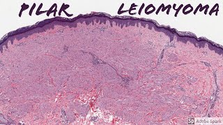 Leiomyoma Pilar Type Piloleiomyoma 5Minute Pathology Pearls [upl. by Pernell621]