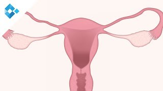 ENDOMETRIOSIS I patogenia síntomas y diagnóstico  Ginecología y Obstetricia [upl. by Delphina431]