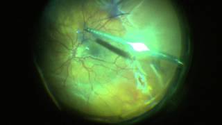 Retinal Detachment Repair with Vitrectomy [upl. by Kathie917]