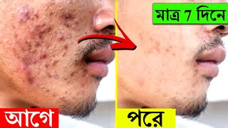 ব্রণ দূর করার সহজ উপায়  How To Remove Pimples Overnight  Acne Blackheads Treatment In Bengali [upl. by Ralyat]