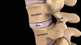 An Alternative to Spinal Fusion Surgery  The Regenexx PercFSU Procedure [upl. by Danyelle]