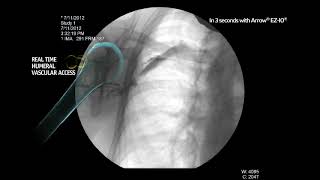 Arrow® EZIO® System  Proximal Humerus Infusion Fluoroscopy Adult Alert Patient [upl. by Noxaj370]