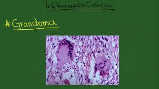 Inflamação Crônica  Resumo  Patologia Geral [upl. by Fitz852]