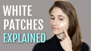 WHITE PATCHES ON THE FACE EXPLAINED PITYRIASIS ALBA DR DRAY [upl. by Urion]