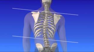 Scoliosis  Curvature of the Spine [upl. by Wallraff]