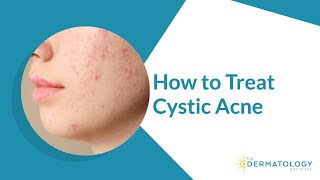 How to Treat Cystic Acne [upl. by Ellemaj909]