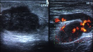 Ultrasonography Tutorial Breast Lump video [upl. by Nadirehs498]