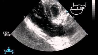 Transesophageal Echocardiography [upl. by Imelida]