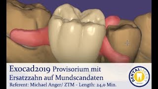 EXOCAD 2019  Tutorial Preview  Provisorium mit Ersatzzahn auf Mundscandaten [upl. by Wolbrom]