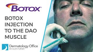 The DAO Muscle  BOTOX® Injections in Dallas [upl. by Avenej]