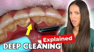 Dental Hygienist Explains Deep Cleaning Procedure [upl. by Oiredised129]