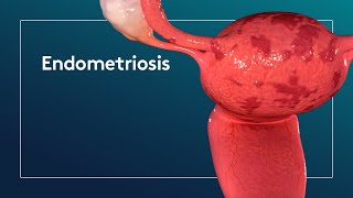 What is Endometriosis [upl. by Toomay]