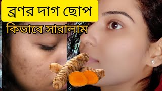 এইভাবে বাড়িতে ব্রণর কালো দাগ ছোপ থেকে চিরতরে মুক্তি  Kacha Holud Face Pack  Spotless Skin [upl. by Held]