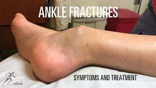 Ankle fracture Types signs and symptoms and treatment [upl. by Dlorej]