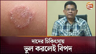 দাদ হলে যে কাজ ভুলেও করবেন না  Ringworm  Health Tips  Channel 24 [upl. by Troyes592]