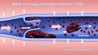 Understanding and Diagnosing Venous Thromboembolism VTE [upl. by Dutch639]