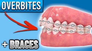 How Do BRACES FIX Overbites  Overbite Before and After Braces  Premier Orthodontics [upl. by Skillern]