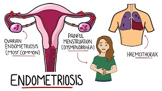 Endometriosis Explained Signs amp Symptoms Diagnosis Pathology Treatment [upl. by Ayor911]