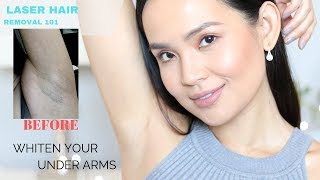 The TRUTH About Laser Hair Removal My Experience  How to lighten underarms [upl. by Kariotta]