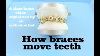 How braces move teeth timelapse  Braces Explained [upl. by Caesaria]