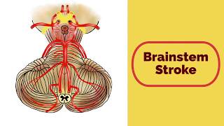 Brainstem Stroke Syndromes [upl. by Cummings]