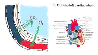 Respiratory Failure [upl. by Towne]