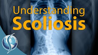 Understanding Scoliosis [upl. by Weidman237]