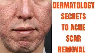 Acne scar treatments ULTIMATE GUIDE [upl. by Jaenicke]