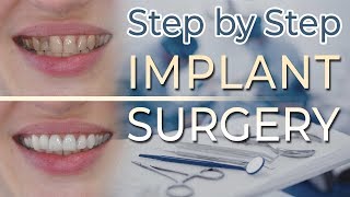 Dental Implant Surgery  Step by Step 27 Extraction and Ridge Preservation [upl. by Ithsav]