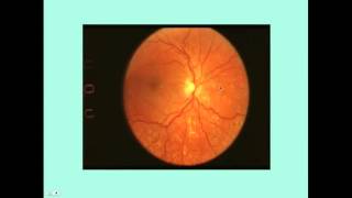 Hypertensive Retinopathy  Stages  KeithWagenerBarker classification [upl. by Greenlee477]