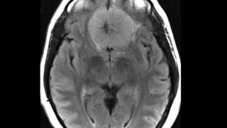 Meningioma Planum Sphenoidale [upl. by Iba]