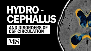 Hydrocephalus And the Disorders of CSF Circulation [upl. by Oderfla]