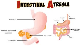 Intestinal atresia amp stenosis [upl. by Wina]