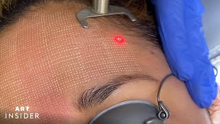 FRAXEL LASER TREATMENT WITH DR STEFANI KAPPEL  FULL FACE BEFORE amp AFTER  EP031 [upl. by Ayihsa]