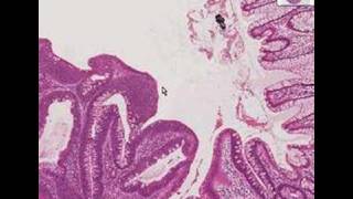 Histopathology ColonTubular adenoma [upl. by Elokin]