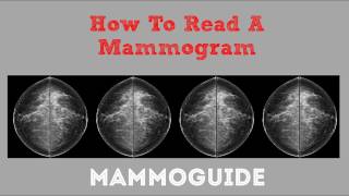 How To Read A Mammogram [upl. by Sikorski]