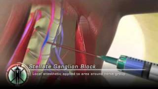 Stellate Ganglion Block Injection [upl. by Lewison]