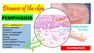 Pemphigoid Causes pathogenesis Types Histopathology Treatment  Pemphigus vs Pemphigoid [upl. by Aihseyn231]