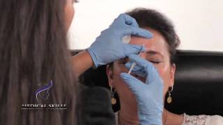 Botulinum Toxin  Injection Technique [upl. by Dupin142]