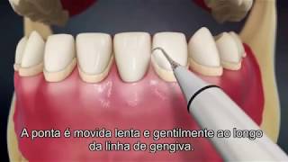 Destartarização Limpeza Dentária [upl. by Alba]