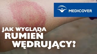 Jak wygląda rumień wędrujący [upl. by Norrad]