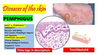 Pemphigus Vulgaris Pathogenesis clinical features oral manifestations  Pemphigus Variants PART 1 [upl. by Winou]