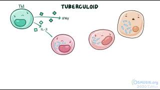 Mycobacterium Leprae  Leprosy  Osmosis [upl. by Monjo]