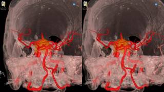 Cavernous Meningioma  3D Virtual Tour  UCLA Neurosurgery [upl. by Novla]