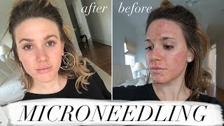 MY FIRST MICRONEEDLING EXPERIENCE amp WHAT TO EXPECT ACNE SCAR TREATMENT [upl. by Attenwad]